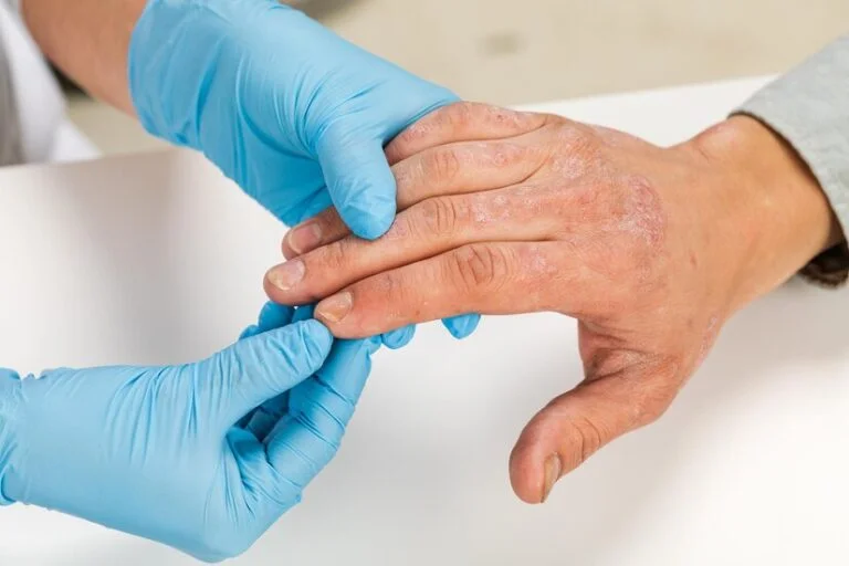 Allergic Dermatosis