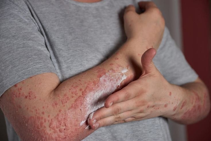 Allergic Dermatosis