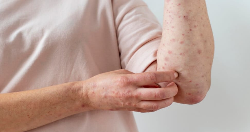 Hives Allergy Treatment by Allergy and Asthma Centre