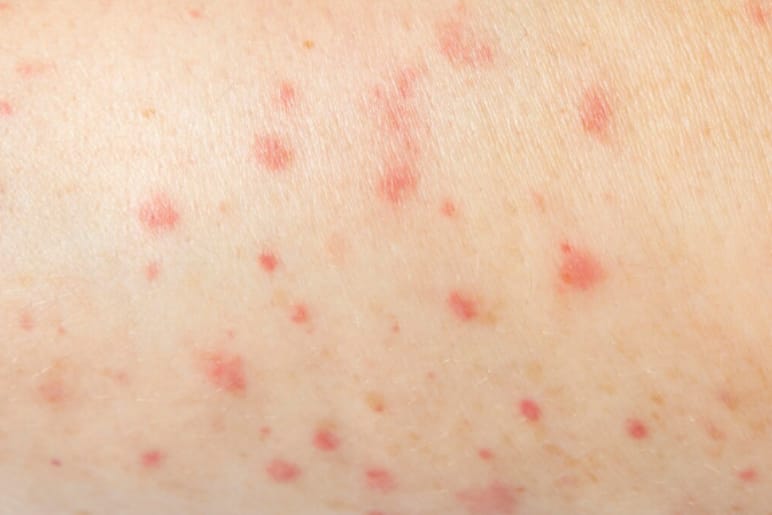 Hives Allergy Treatment by Allergy and Asthma Centre in Kolkata