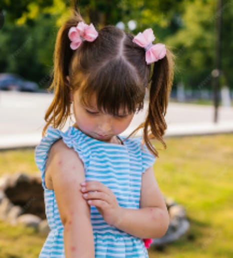 Hives in Children