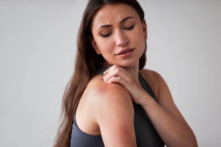 Hives Allergy in Women