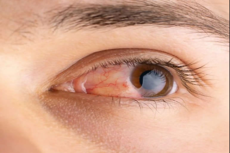 Seasonal Eye Allergies | Allergy Asthma